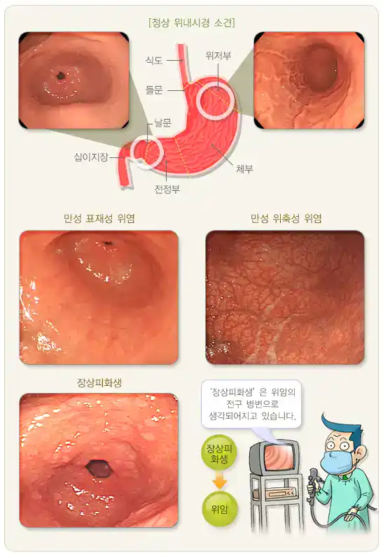 정상 위내시경 사진,만성 표재성 위염,만성 위축성 위염, 장상피화생 사진 이미지