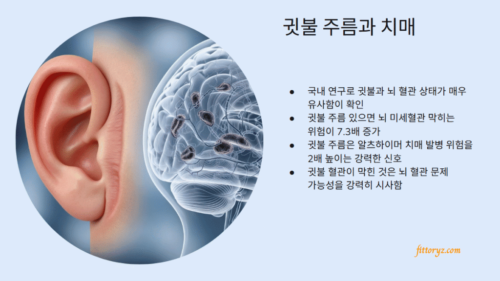 귓불주름과 치매
-국내 연구로 귓불과 뇌 혈관 상태가 매우 유사함이 확인
-귓불 주름 있으면 뇌 미세혈관 막히는 위험이 7.3배 증가
-귓불 주름은 알츠하이머 치매 발병 위험을 2배 높이는 강력한 신호
-귓불 혈관이 막힌 것은 뇌 혈관 문제 가능성을 강력히 시사함
